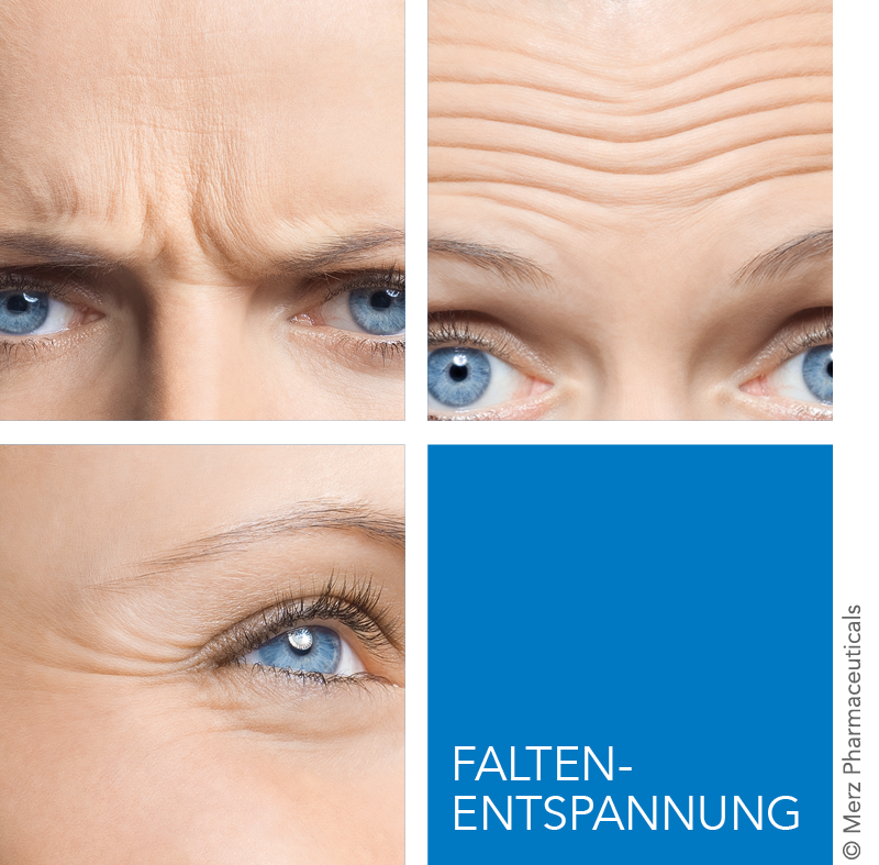 Behandlungsareale für Botulinumtoxin im Gesicht