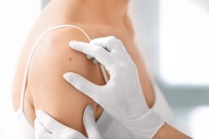 Hautärztliche Untersuchung eines Muttermals zur Hautkrebsvorsorge