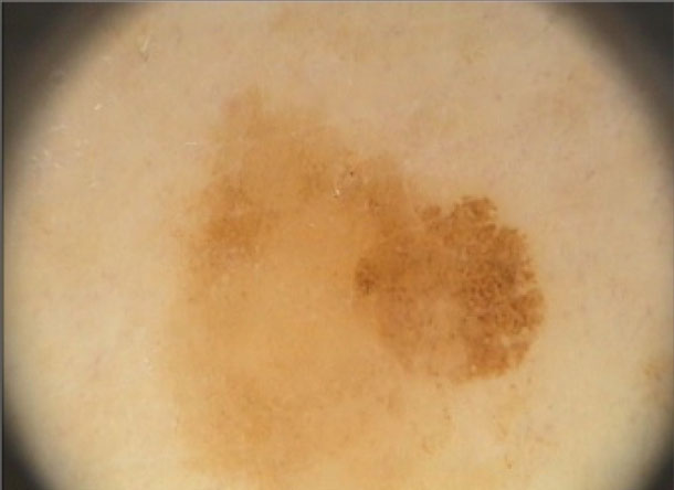 ABCDE-Regel: C wie Coloration